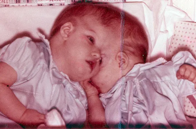 Remembering Lori and George Schappell: The Remarkable Journey of the World's Oldest Conjoined Twins